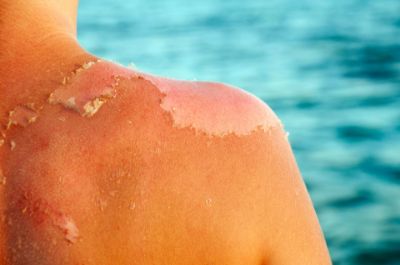 How to take care of sunburned skin? 